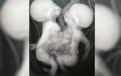 Siamesas passam por cirurgia de separação