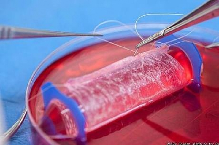 Médicos implantam vagina construída em laboratório
