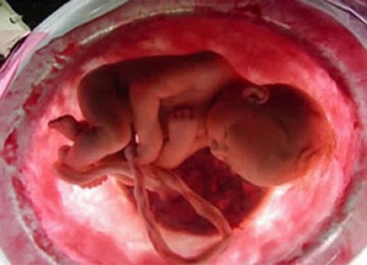 Cresce o número de mães que armazenam as células-tronco do cordão umbilical de seus bebês