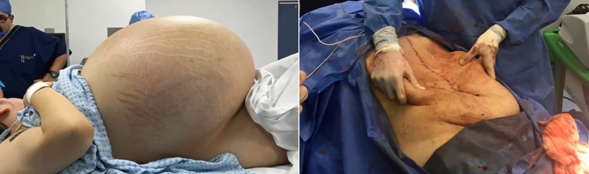 Médicos retiram cisto ovariano de 32 quilos de paciente no México 