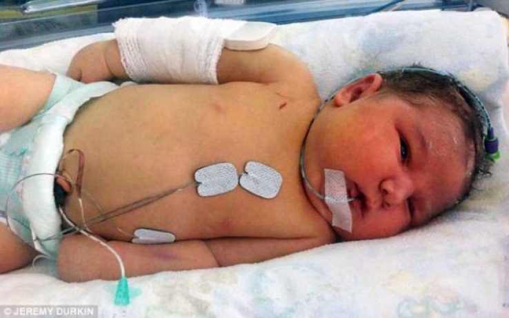 Médico quebra braço de bebê gigante durante parto para salvar vida da criança 