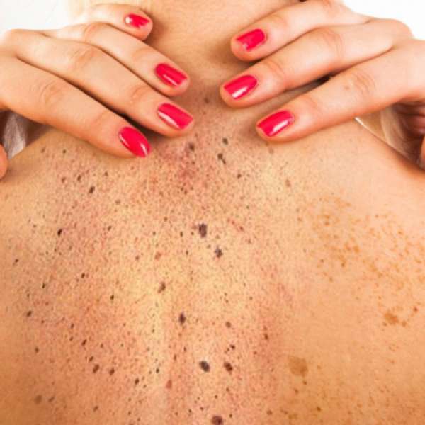 MT registra 4 mil casos de câncer de pele