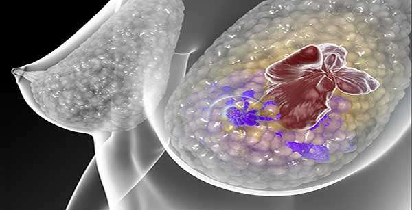 Ciência avança em terapia contra tipo mais agressivo de câncer de mama