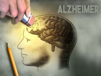 Nova droga ataca uma das origens da doença de Alzheimer
