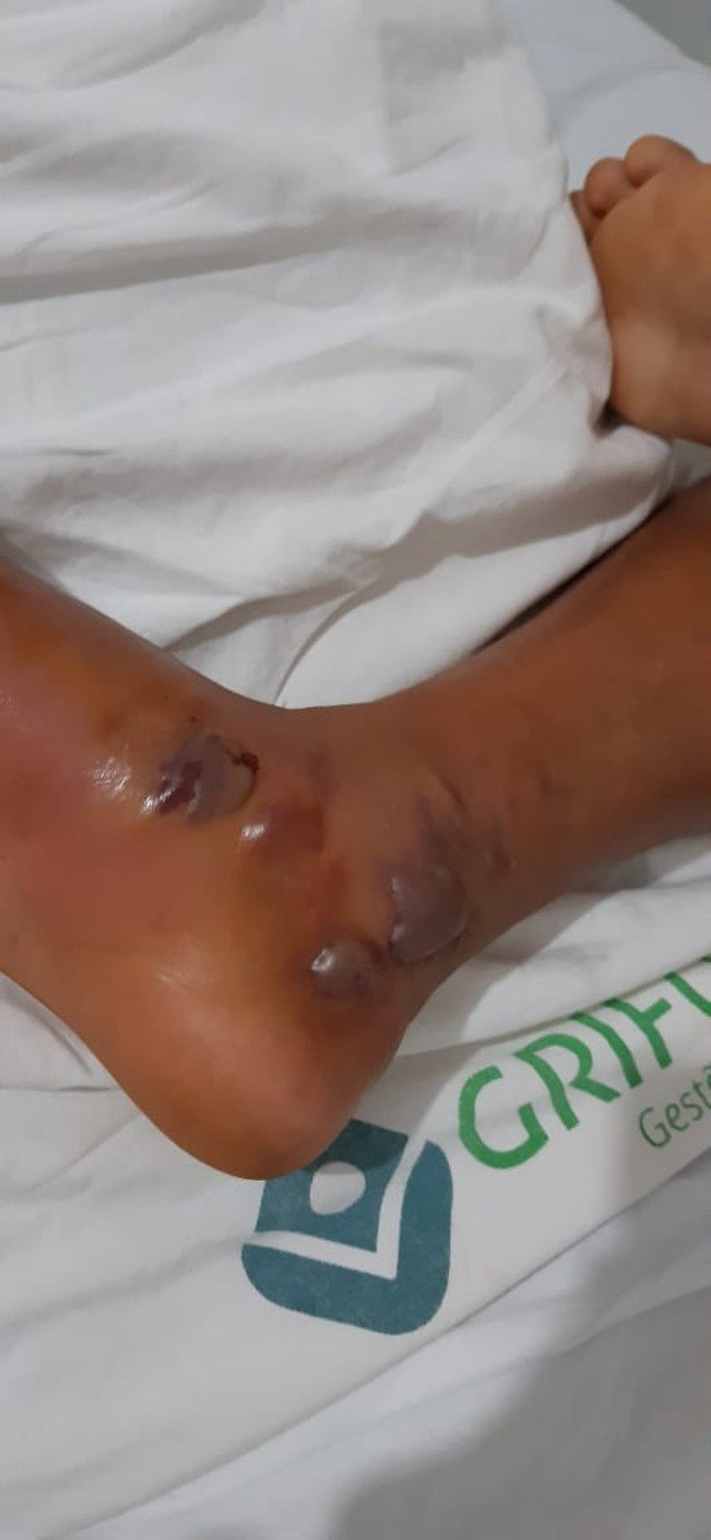 Menino de 12 anos pisa em jararaca em sítio, é picado e está internado há 8 dias em MT