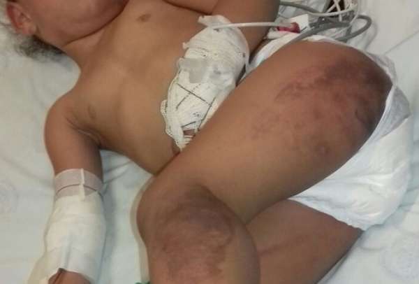 Criança de três anos chega desmaiada em hospital após ser espancada pelo padrasto