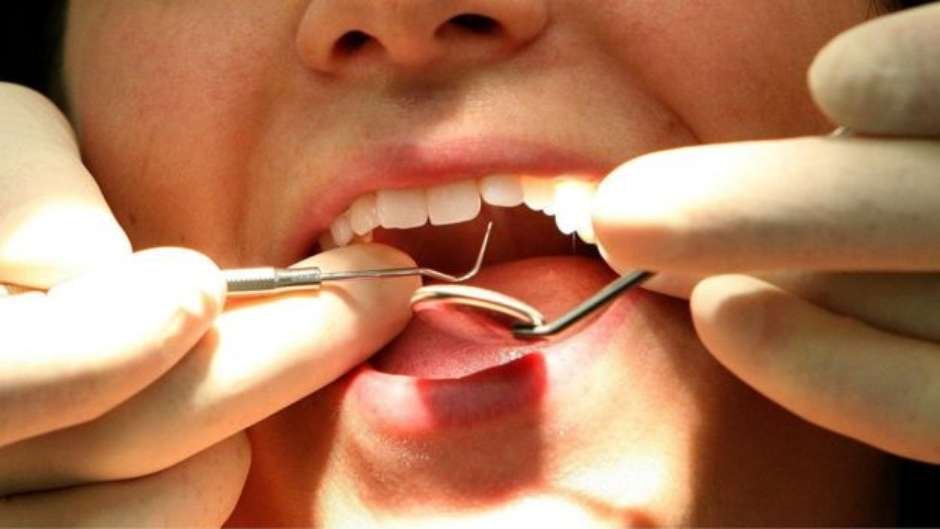 Cientistas britânicos criam substância que pode regenerar dentes e aposentar obturações 
