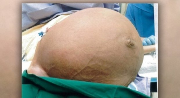 Mulher retira tumor de 10 quilos da barriga