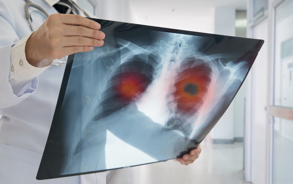 Câncer de pulmão: 90% dos diagnósticos estão relacionados ao fumo