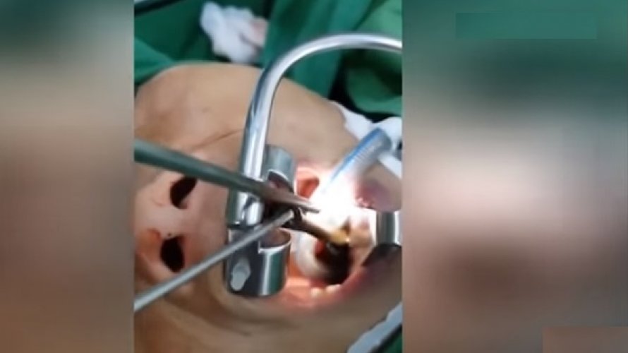 Cirurgião retira sanguessuga da garganta de paciente