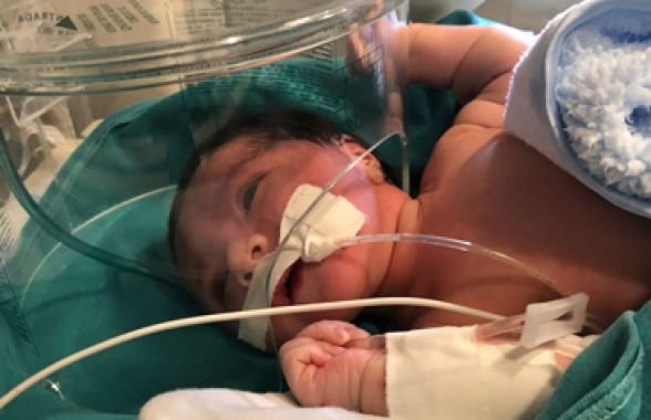 Bebê enterrada viva piora, respira com aparelho e passa por cirurgia de emergência