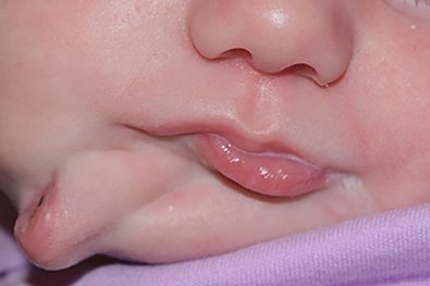 Bebê nasce com duas bocas e faz cirurgia
