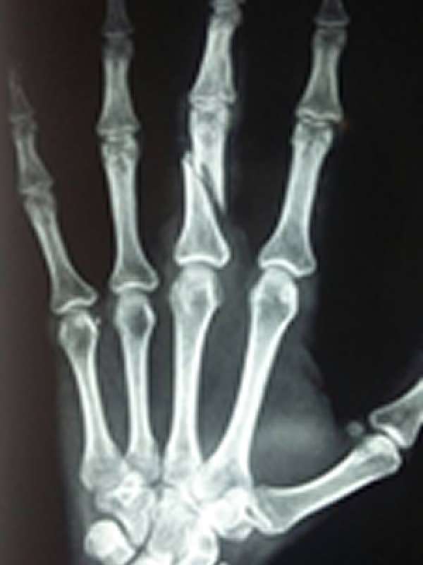 Paciente quebra dedo de médica em MT após não conseguir medicamento