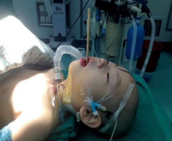 Criança chinesa fica com palito alojado em seu cérebro, depois de tropeçar e cair em cima dele, enquanto brincava com os amigos