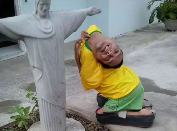 Brasileiro de 37 anos nasceu com a cabeça virada para baixo