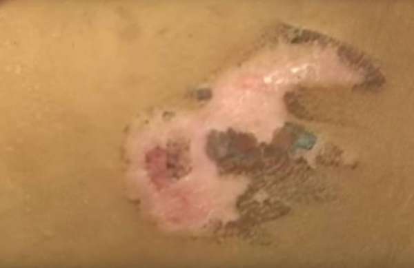 Castigo cruel: mulher queima o rosto do filho de quatro anos com garfo quente