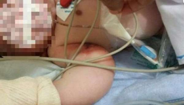 Médico força parto e bebê nasce com braços quebrados