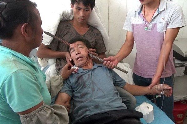 Homem sobrevive após barra de ferro atravessar sua cabeça em acidente