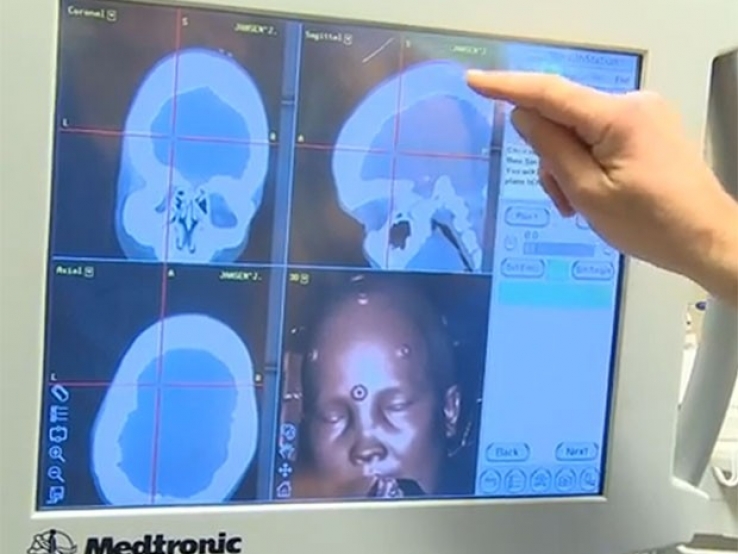 Médicos trocam crânio de mulher por prótese de plástico impressa em 3D C