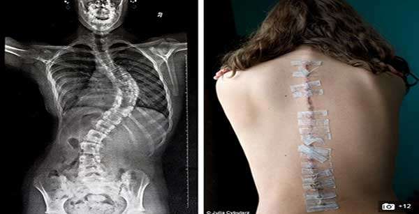 Menina com coluna deformada retrata dia a dia de sofrimento para se curar